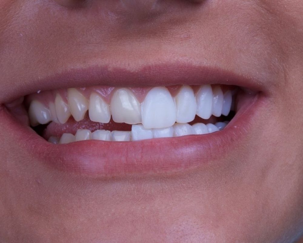 Bonding - nieinwazyjna metoda odbudowy zębów